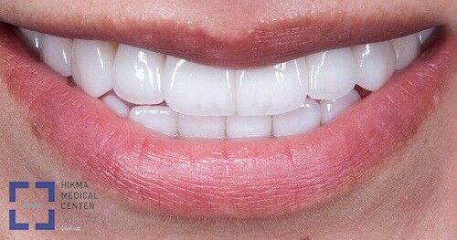 The Cost of Invisalign vs Traditional Braces: Which is More Cost-Effective?